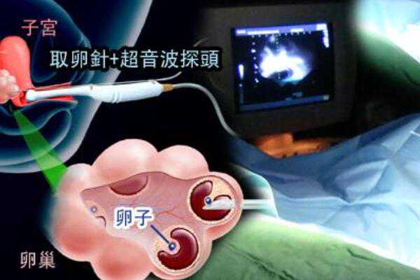 黑龙江哪家医院代生,姐妹有幼稚子宫，在黑龙江安达能不能做试管婴儿？